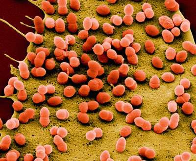 Vi khuẩn Hib gây ra nhiều căn bệnh nguy hiểm