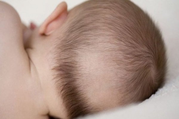 Is newborn hair loss normal? | Vinmec