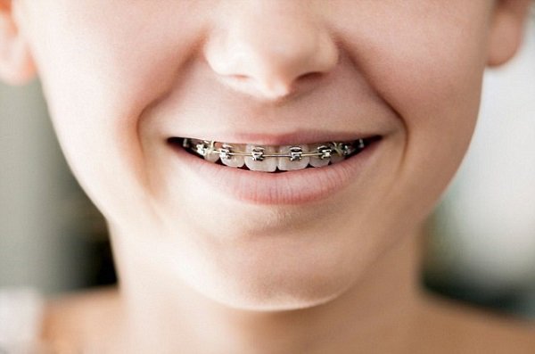 8-10 tuổi là độ tuổi niềng răng cho trẻ thích hợp nhất