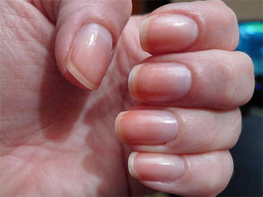 Vitamin B12: Signs of B12 deficiency on nails