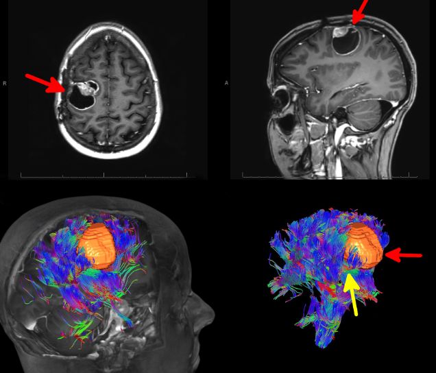 Chụp cộng hưởng từ các bó sợi thần kinh để chẩn đoán bệnh lý u não xâm lấn