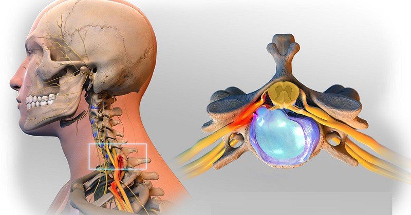 Kết quả chụp CT giúp chẩn đoán thoát vị đĩa đệm cột sống cổ
