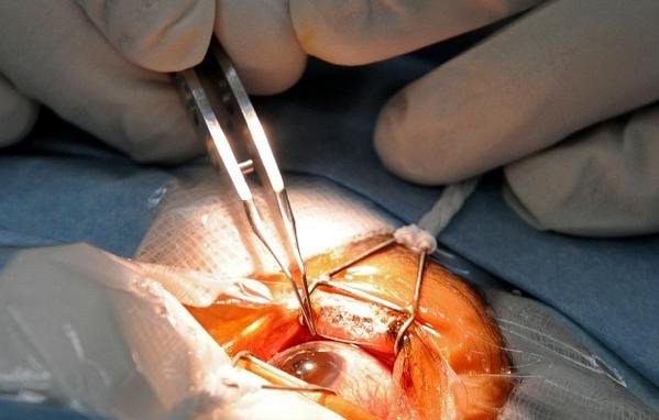 Phẫu thuật thủy tinh thể giúp cải thiện thị lực của người bệnh