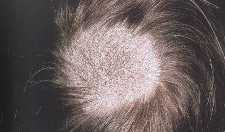 Làm sao giải quyết tình trạng nấm da đầu gây rụng tóc nhanh chóng? - iCare  Pharma