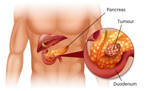 Ung thư tuyến tụy gây ra bệnh tiểu đường