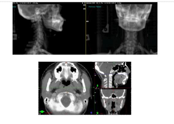 Chụp xác minh X-quang 2 chiều và 3 chiều CBCT đảm bảo chiếu xạ đúng vị trí khối u cần xạ.
