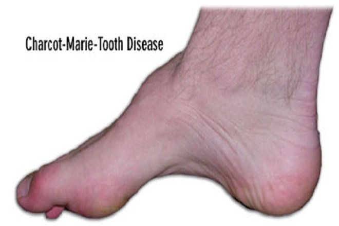 bệnh Charcot-Marie-Tooth (bệnh teo cơ mác)
