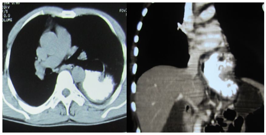Hình ảnh CT scan thoát vị khe hoành loại II