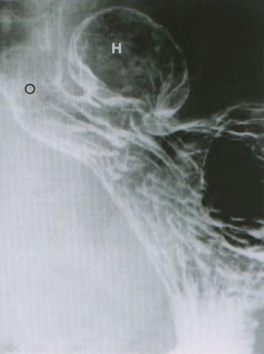 X quang thực quản - dạ dày cản quang TVKH loại II