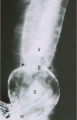 X quang thực quản - dạ dày cản quang TVKH loại I