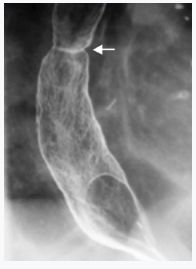 Hình ảnh màng ngăn thực quản trên X quang thực quản dạ dày cản quang với thuốc cản quang Baryt