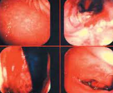 Hình ảnh nội soi của viêm dạ dày do bạch cầu ái toan
