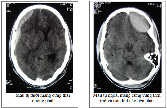Chụp CT não - phương pháp chẩn đoán chính xác bệnh lý về não