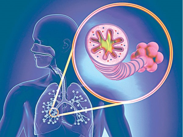 Bệnh nhân mắc phổi tắc nghẽn mạn tính thường phải sử dụng liệu pháp thở oxy liều cao qua ống thông mũi