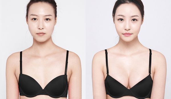 What is the perfect breast augmentation size? - Quora