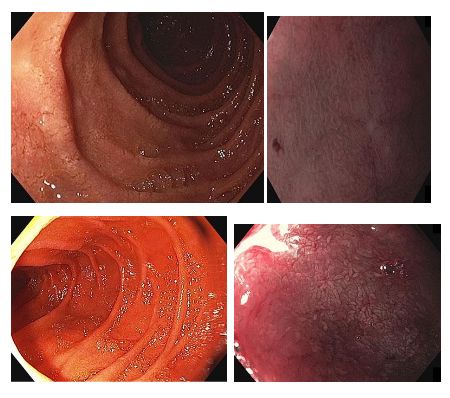 Hình ảnh phía trên bên trái trình bày chẩn đoán ban đầu của bệnh Celiac với các vết nứt trên các nếp gấp niêm mạc và không có nhung mao khi hình ảnh niêm mạc được quan sát  bằng chế độ nội soi nhuộm màu NBI và chế độ lấy nét gần (Near Focus) trong hình ản