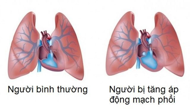 tăng áp động mạch phổi