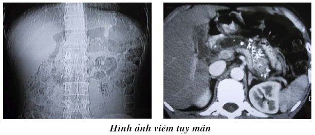 Hình ảnh viêm tụy mãn tính CT