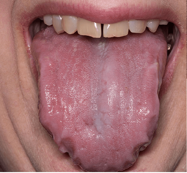 Lưỡi phì đại có thể là một dấu hiệu của bệnh amyloidosis