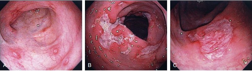 Hình ảnh loét đại tràng đa ổ do bệnh Crohn