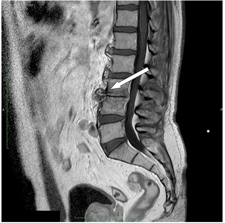 Hình ảnh viêm đĩa đệm đốt sống trên MRI