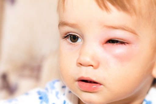 Viêm mô tế bào quanh hốc mắt ở trẻ