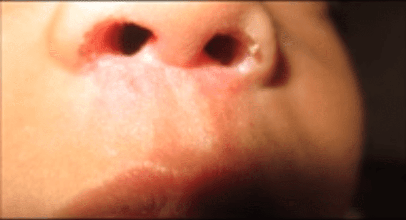 Bé 13 tháng tuổi có những nốt phồng nhỏ rộp lên trong hốc mũi là dấu hiệu của bệnh gì?