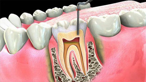 Đau phần tủy răng của răng hàm đã bọc sứ được 2 năm có phải lấy tủy và hàn lại răng không?