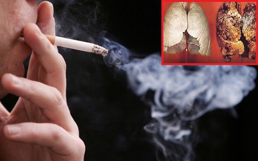 ung thư phổi do hút thuốc lá