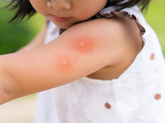 Những điều cần biết về sốt xuất huyết và cách phòng tránh bệnh