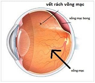 Phương pháp điều trị và khắc phục cận thị nặng và thoái hóa võng mạc một bên mắt trái ở trẻ 8 tuổi là gì?