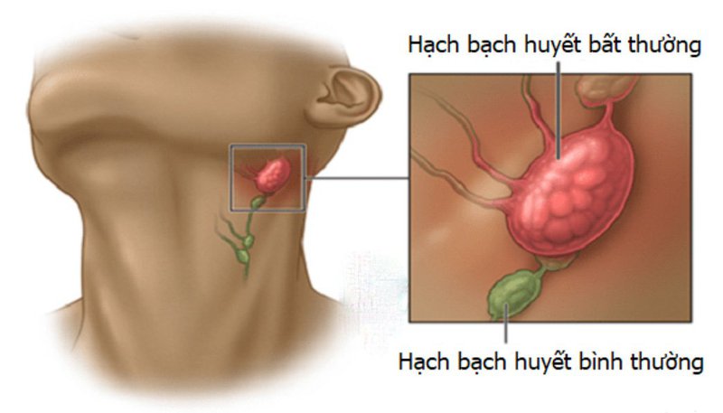 Bị viêm hạch lympho có phải ung thư vòng họng không?