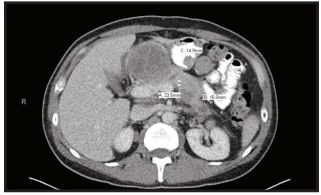 Chụp CT Scan bụng cho thấy phúc mạc của ổ bụng bị xâm lấn dọc theo vách sau dạ dày và một nốt 1,5 cm trên mặt sau của hang vị dạ dày.