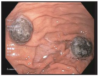 Hình ảnh nội soi dạ dày: tổn thương thâm nhiễm kích thước khoảng 1,5cm rải rác ở thân dạ dày.