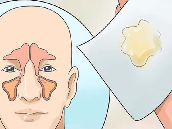 Thường xuyên thấy máu khô dính trên vảy mũi là dấu hiệu của bệnh gì?