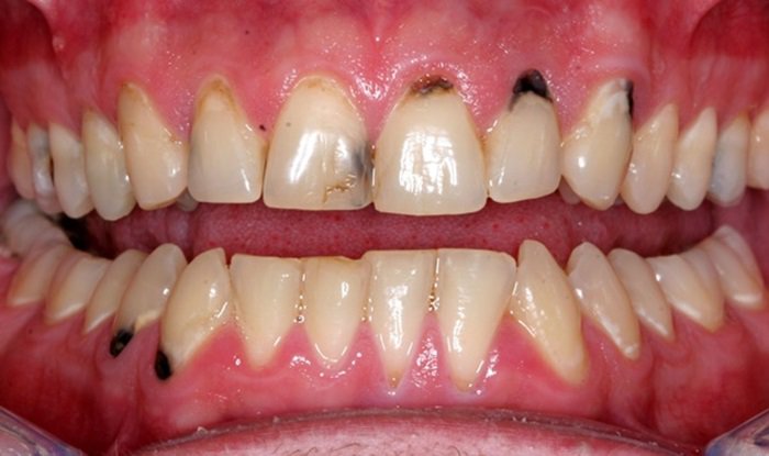 Tại sao bị sâu răng không được tẩy trắng răng?