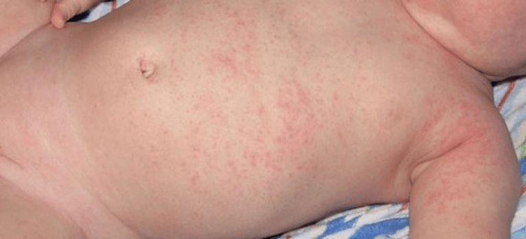 Trẻ 4 tháng tuổi nổi chấm đỏ trên bụng sau khi hạ sốt là dấu hiệu bệnh gì?