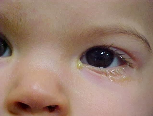 Ra nhiều gỉ mắt kèm nước mắt sau thông lệ đạo có sao không?