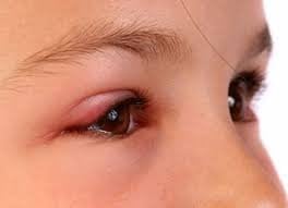 Viêm kết mạc mắt ở trẻ