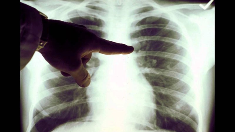 Qua CT, X-quang có chẩn đoán chính xác được viêm phổi áp xe và ung thư phổi hay không?