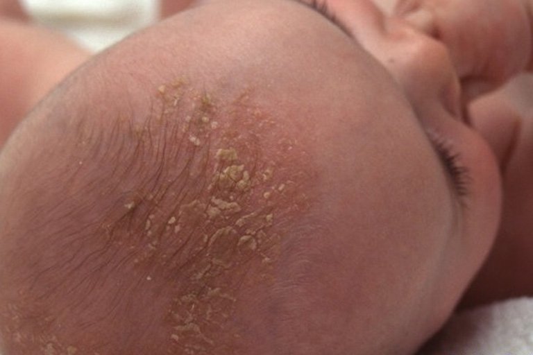 Nguyên nhân da đầu trẻ sơ sinh có mùi hôi?