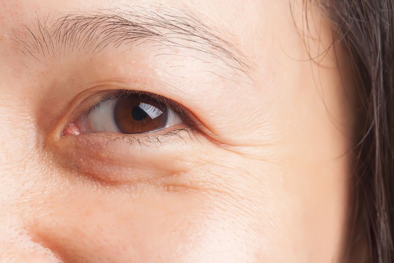 Lão hóa da vùng mắt là một dấu hiệu phổ biến của tuổi già
