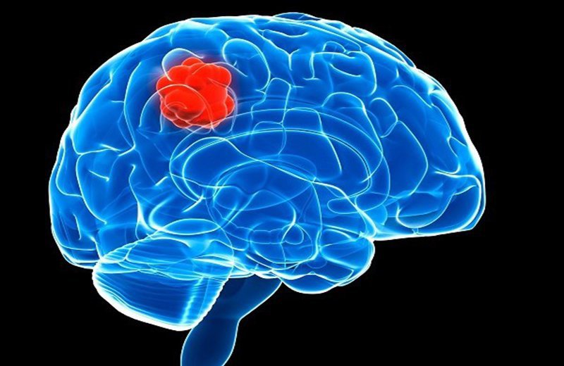 U não đã mổ tái phát gây đau đầu phải làm thế nào?