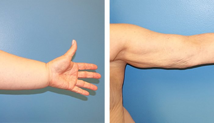 Tế bào gốc từ mỡ hút (liposuction) tự thân cải thiện chức năng cánh tay của các bệnh nhân bị phù bạch huyết sau điều trị ung thư vú