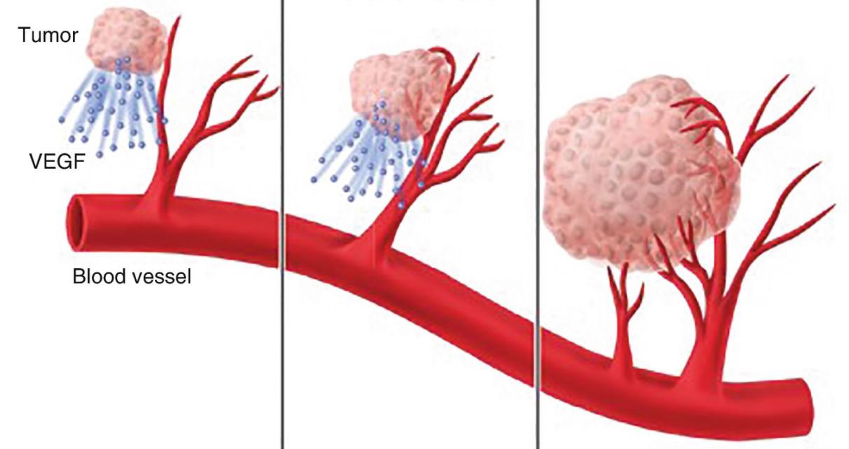 Yếu tố tăng trưởng nội mô mạch máu trong ung thư tụy