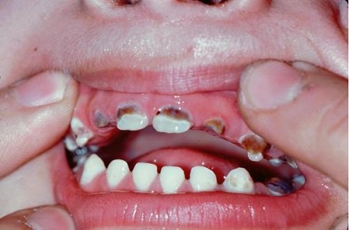 Trẻ 4 tuổi đau nhức sâu răng kéo dài điều trị dứt điểm thế nào?