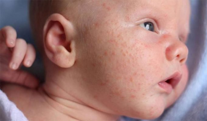 Trẻ 1,5 tháng tuổi nổi mụn đỏ, xuất hiện vết tròn trắng ở má là dấu hiệu bệnh gì?