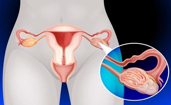 Bột talc trong mỹ phẩm có nguy cơ gây ung thư buồng trứng ở nữ giới