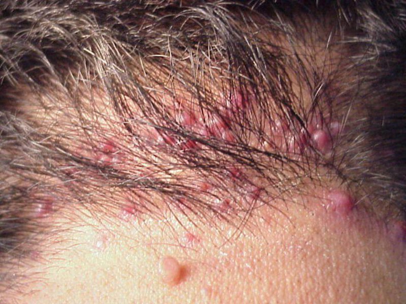 Nổi cục nhỏ đau, mủ đầu trắng, cứng ở vùng da đầu là dấu hiệu bệnh gì?