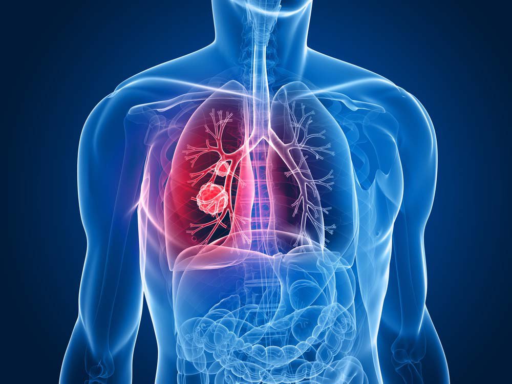 Chụp pet phổi phân loại ung thư phổi
